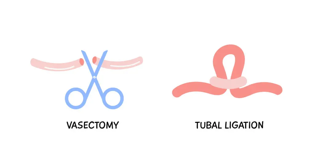 Choosing Between A Vasectomy Vs Tubal Ligation Upstate Urology