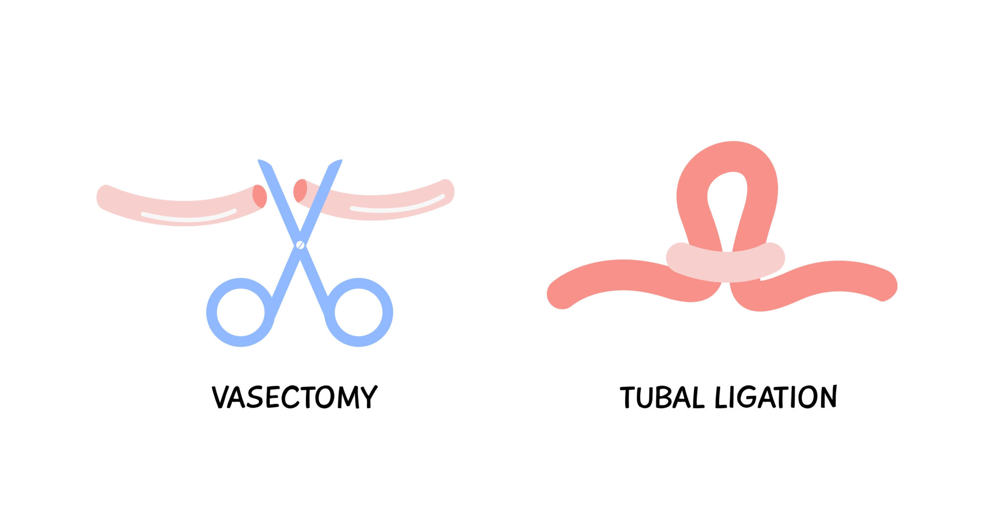 Diagram showing the difference between tubal litigation vs vasectomy