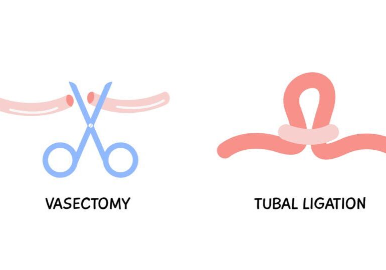 Diagram showing the difference between tubal litigation vs vasectomy
